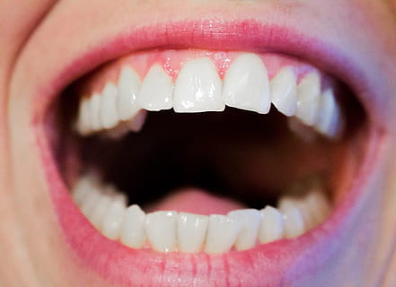 8 Cara Menghilangkan Karang Gigi Secara Alami Di Rumah yang Wajib Dicoba!